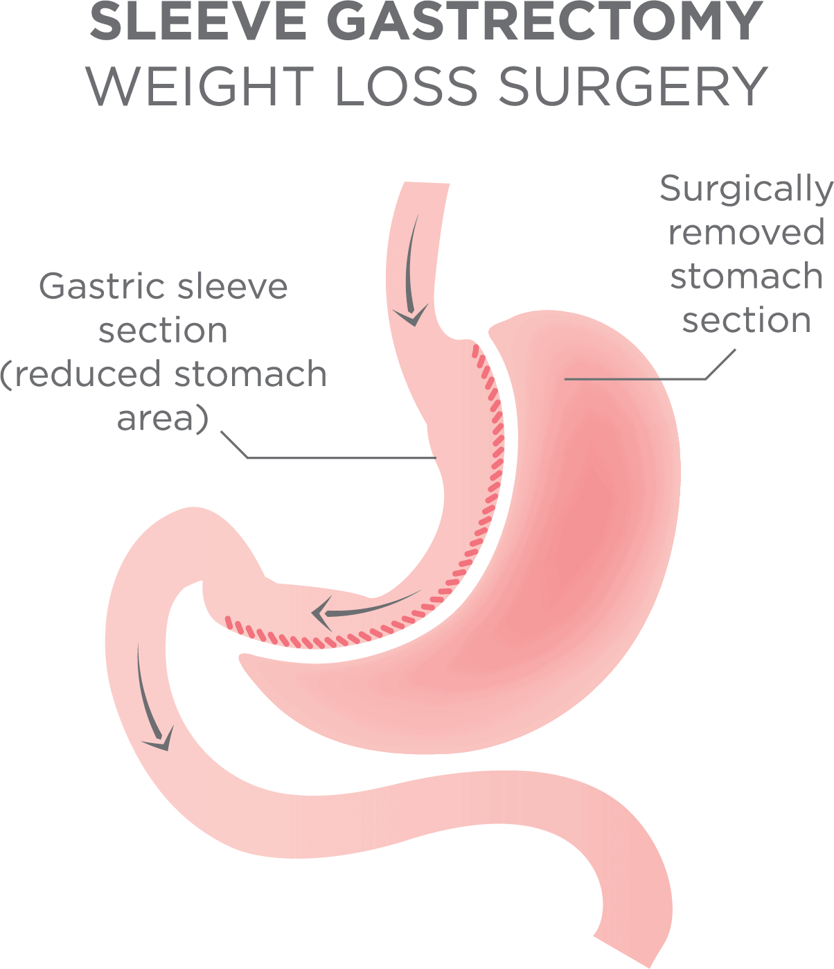 Bariatric Vitamins For Gastric Sleeve