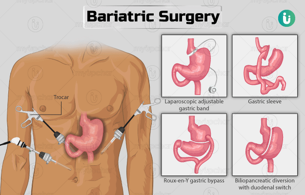 Bariatric Vitamins After Surgery