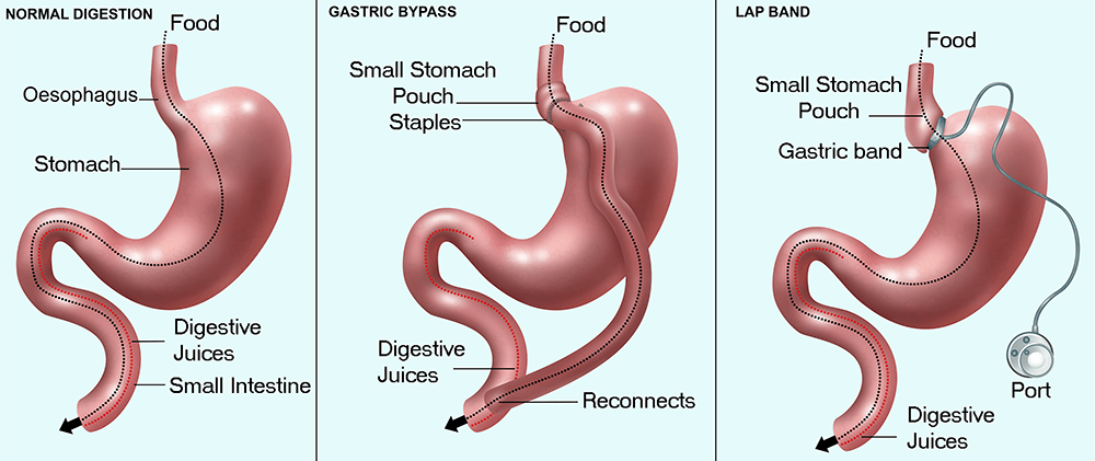 Bariatric Recipes Gastric Bypass