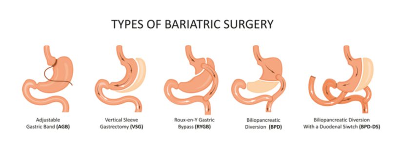 Bariatric Grade Vitamins